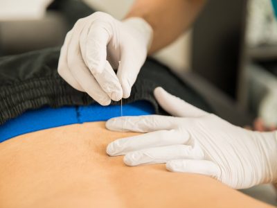 back-pain-treated-with-dry-needling